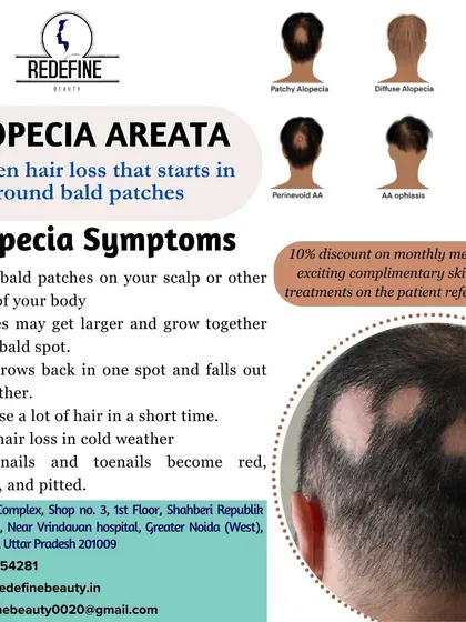 This infographic helps you understand Alopecia Areata, its different types, and common symptoms like small bald patches and sudden hair loss. Knowing the signs is the first step toward getting the right help.