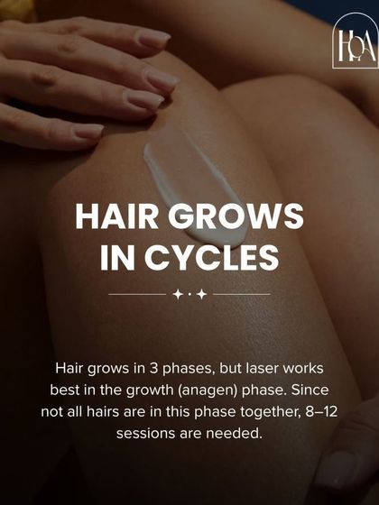 Understanding the science helps set expectations. Hair grows in three phases, and laser is most effective during the active growth (anagen) phase. This is why multiple sessions are necessary to catch every hair in the right cycle.