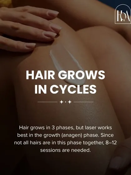 Understanding the science helps set expectations. Hair grows in three phases, and laser is most effective during the active growth (anagen) phase. This is why multiple sessions are necessary to catch every hair in the right cycle.