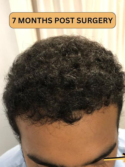 7 months post-surgery. Significant growth is now visible. The hair is getting longer and thicker, showing the fantastic progress of the transplant.