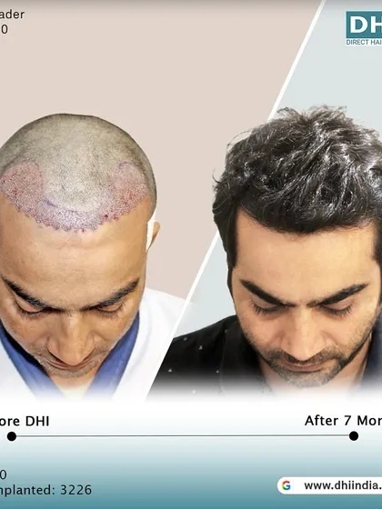 This image shows the client's head immediately after the procedure compared to the 7-month result. It provides a transparent look at the process and the excellent growth achieved.