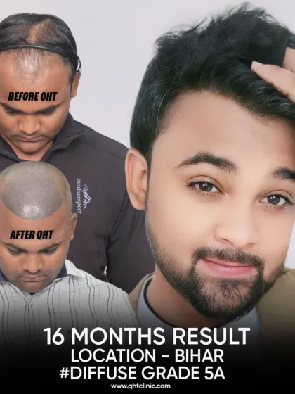 A complete transformation for our patient from Bihar. In 16 months, we addressed his Grade 5A diffuse thinning with 4400 grafts, restoring his hairline, mid-scalp, and most importantly, his smile.