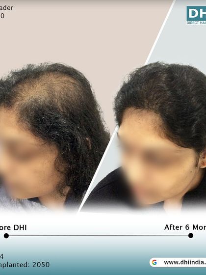A side-profile view of a 34-year-old female client 6 months after her no-shave hair transplant. We implanted 2,050 hairs to restore her hairline, achieving a natural and beautiful result.