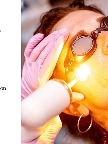 The AdvaTx laser is a key part of my bridal packages. Its benefits include reducing pigmentation, evening out skin tone, fading acne scars, and boosting collagen for an instant, radiant glow with no downtime.