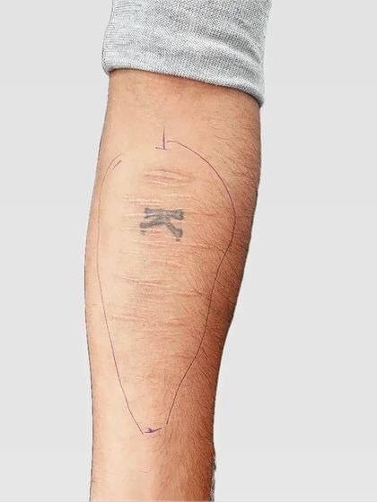 Scar Cover-ups: Turning Scars into Art photo 5