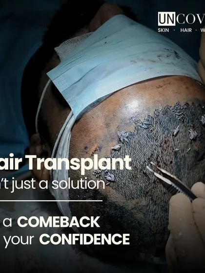 For many, a hair transplant is more than just a procedure; it's a comeback for your confidence. We use advanced techniques to provide natural-looking, lasting results for those dealing with significant hair loss or balding. It's about restoring not just your hairline, but also how you feel.
