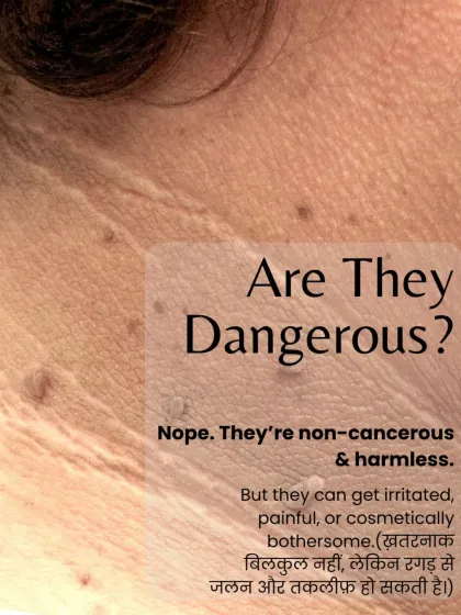A common question I get is whether skin tags are dangerous. The answer is no, they are non-cancerous. However, they can become irritated and painful, which is a valid reason for removal.