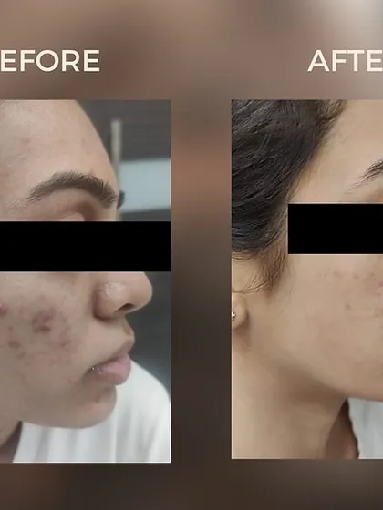 Acne scars require a targeted approach. This before-and-after showcases the result of our advanced microneedling RF treatment, which effectively resurfaces the skin and reduces the appearance of deep-set scars for a much smoother texture.