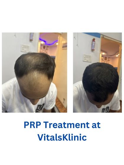Vitals Klinic - Hair Restoration & Treatment Non-Surgical Hair Regrowth: PRP & GFC Therapy photo 5