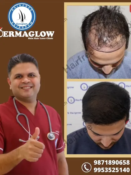 This client's result after an 11-month period involved the transplantation of 3200 grafts. The procedure effectively filled in the thinning crown and reinforced the hairline, leading to a much fuller head of hair.