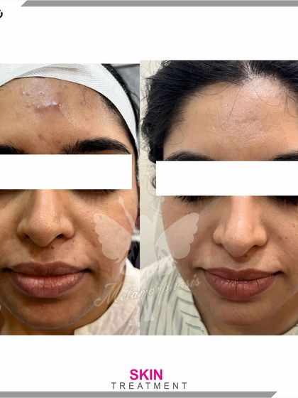 This before-and-after demonstrates the effectiveness of our treatments on forehead acne and scarring.