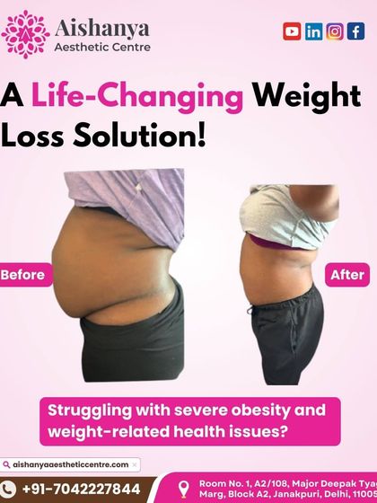 This before-and-after image shows a real patient's result from a body contouring procedure. For those struggling with stubborn fat or obesity-related issues, this can be a life-changing solution to achieve a healthier shape.