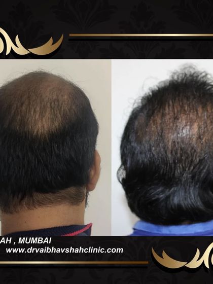 This image shows the result of filling in the crown area, providing the patient with a much fuller look from the back.