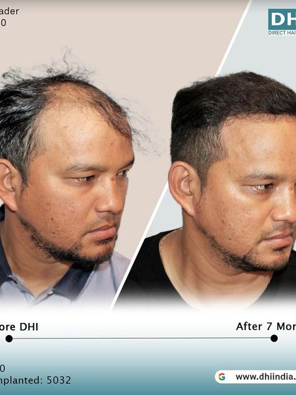 A before and after of a 30-year-old client 7 months after receiving 5,032 implanted hairs. The transformation is remarkable, with a restored hairline and excellent density.