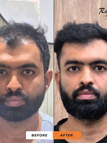 A frontal before-and-after of the patient from video 17. The change is dramatic, restoring his hairline and giving him a more youthful and confident appearance.