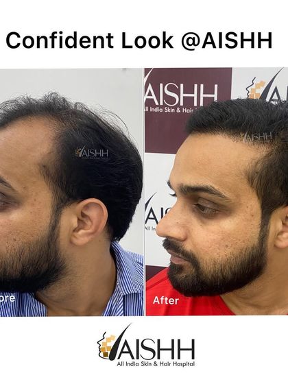 The side profile is just as important as the front. This image shows how we created a natural-looking temple and side hairline that seamlessly blends with his existing hair.