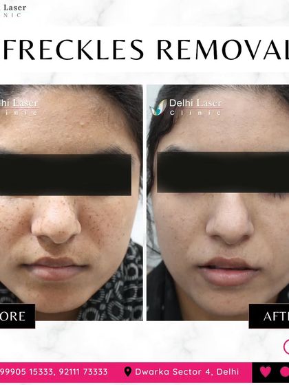 This before-and-after result for freckle removal demonstrates the precision of the Q-Switch laser. The treatment specifically targets the pigmented cells without harming the surrounding skin.