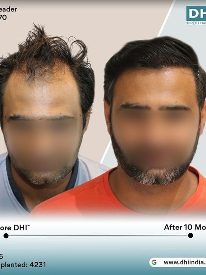 Another side-profile view of the 10-month result. This angle highlights the seamless flow and density from front to back, a testament to the meticulous work of our doctor-led team.