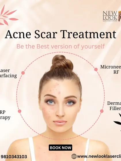 We offer a comprehensive range of solutions for acne scars, because no two skin types are the same. This visual outlines some of our most effective approaches, including Laser Resurfacing, Microneedling RF, PRP Therapy, and Dermal Fillers, all tailored to your specific needs after a thorough skin analysis.