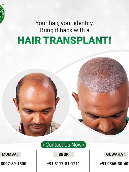 This graphic shows the transformation from a bald scalp to a head full of newly implanted grafts. It’s a clear illustration of the FUE process and the first step towards new hair growth.