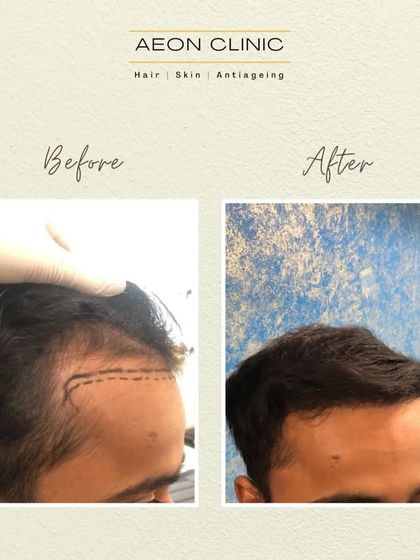 A close-up of a hairline transformation. The 'after' photo shows a dense, well-defined hairline that perfectly frames the face.