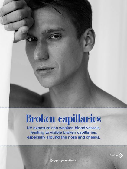 UV exposure can also weaken blood vessels, leading to broken capillaries that become visible around the nose and cheeks.