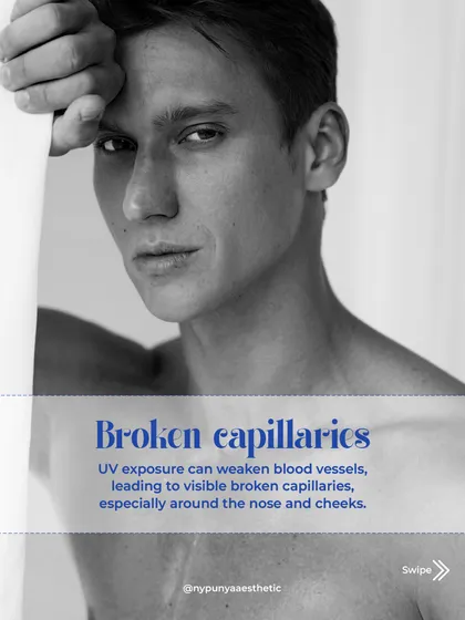 Did you know UV exposure can weaken blood vessels? This leads to visible broken capillaries, especially around the nose and cheeks, which is another form of sun damage.