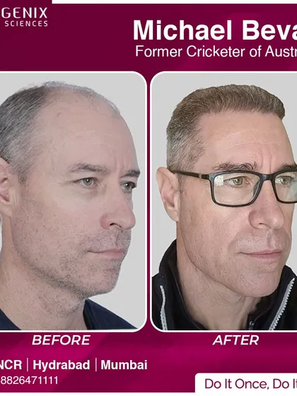 The before and after transformation of former Australian cricketer Michael Bevan, showcasing our global appeal among sports icons.