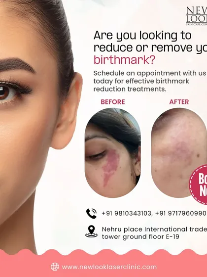 This graphic shows a real client's progress in birthmark reduction. We provide effective treatments to help you feel more confident in your skin, starting with a simple booking for a consultation.