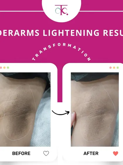 This is a real result from my underarm lightening treatment. Using a gentle, customized chemical peel, we can significantly reduce pigmentation over a few sessions, helping you feel confident enough to wear whatever you want. No harsh bleach, just a safe and effective process.