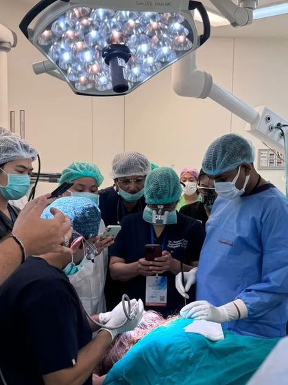Another angle from our live surgery demonstration in Bangkok. Notice the use of high-magnification loupes, a standard I instill for precision work in FUE surgery.