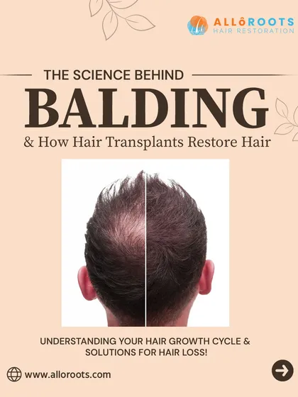 Balding occurs when the hair growth cycle is disrupted and follicles shrink, often due to genetics, hormones, or stress. Understanding this science is the key to reversing it. With proven medical treatments, we can address the root cause and restore hair permanently.