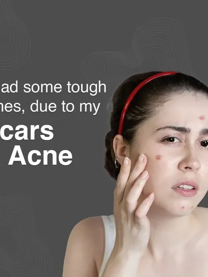I know the tough times that acne and scars can cause. My goal is to provide effective treatments that not only heal your skin but also restore your confidence.