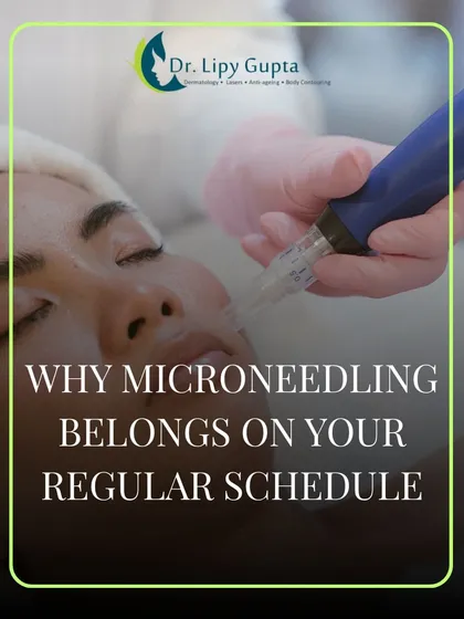 This image shows a microneedling session in progress. Regular treatments are key to building and maintaining collagen for long-term skin health and preventing early signs of aging.