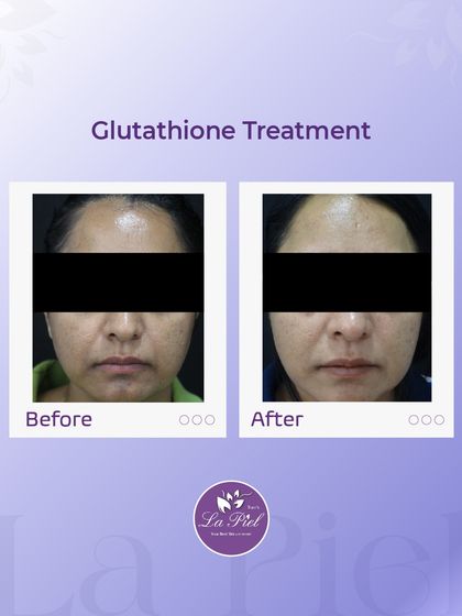 Glutathione is a powerful antioxidant that I use to help brighten the skin and improve its overall tone. This before-and-after shows how the treatment can contribute to a more luminous and even complexion by reducing oxidative stress in the skin.