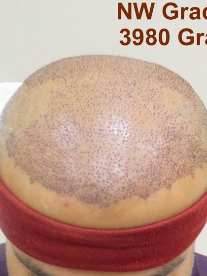 A different view of the same 3980-graft Giga Session, showing the clean work and extensive coverage achieved. The headband helps prevent post-operative swelling.