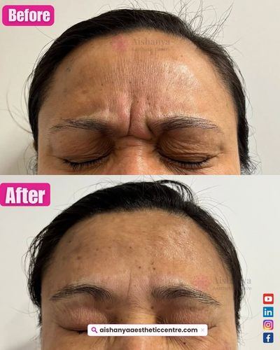 Cosmetic Injectables & Thread Lifts