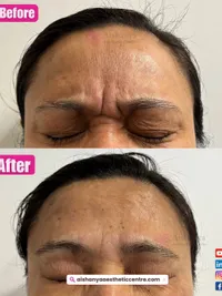 Cosmetic Injectables & Thread Lifts