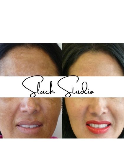 From a dull complexion to a radiant glow, this before-and-after shows a remarkable improvement in skin brightness and clarity.