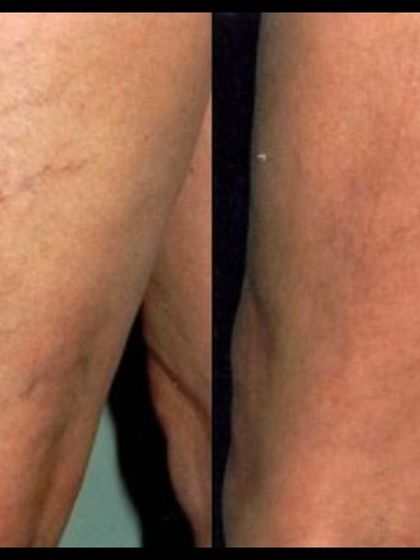 This is another powerful before-and-after of microsclerotherapy. Using tiny injections, I can effectively treat spider veins on the legs, giving my patients the confidence to show off their skin.