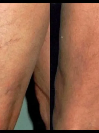 This is another powerful before-and-after of microsclerotherapy. Using tiny injections, I can effectively treat spider veins on the legs, giving my patients the confidence to show off their skin.