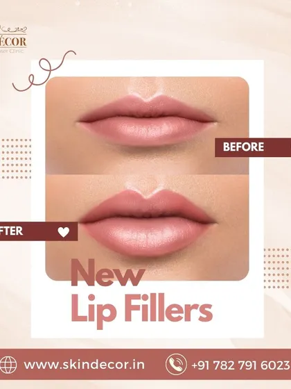 A before and after look at the subtle, natural enhancement achieved with our new lip fillers. My goal is always to restore balance and volume for a result that boosts confidence while looking like you.