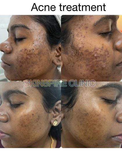 This patient's journey involved managing breakouts and improving skin texture. Notice the reduction in both active pimples and older marks, leading to smoother, clearer skin.