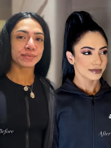 For skin with active acne, my process is all about careful skin prep and precise application. This transformation shows how I achieve a smooth, full-coverage base that looks natural and feels comfortable, without irritating the skin.