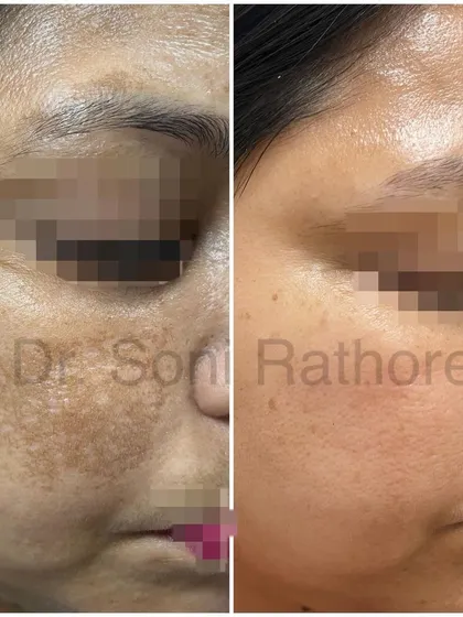 This before and after image showcases a significant reduction in melasma. We achieved this result through a multi-faceted approach including prescription creams, a series of chemical peels for pigmentation, and targeted laser treatments.