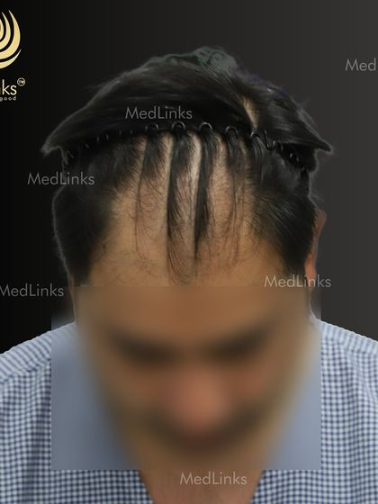 A top-down view of the patient's hair loss before the transplant.