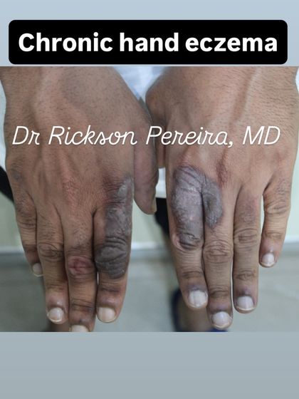 This was the initial presentation of severe, itchy chronic hand eczema that had been resistant to treatment for two years. The thickened, inflamed skin caused significant discomfort and frustration for the patient.