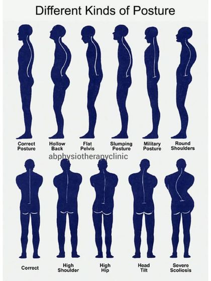 Your posture is your foundation. This chart shows various common postural deviations, from a hollow back and rounded shoulders to scoliosis. I conduct a full assessment to identify your specific pattern and create a corrective plan.