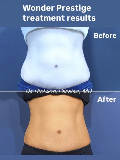 This before and after showcases the targeted fat reduction possible with our Wonder Prestige treatment. This non-invasive technology helps sculpt the abdomen by stimulating intense muscle contractions, leading to a reduction in subcutaneous fat and a more toned appearance, all without downtime.