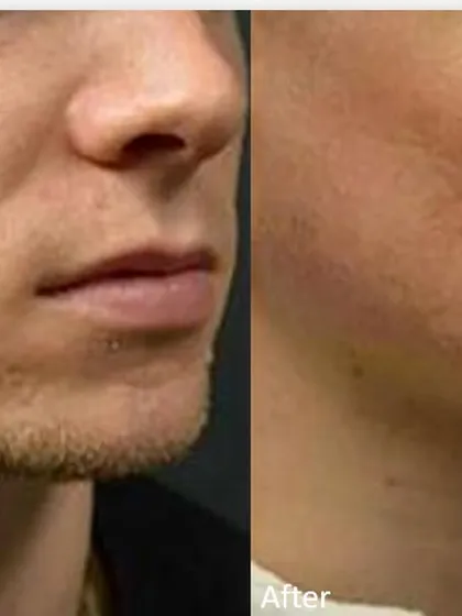 For this male patient, MNRF was used to significantly reduce the depth of acne scars and improve overall skin texture. This treatment rebuilds the skin from within for lasting results.